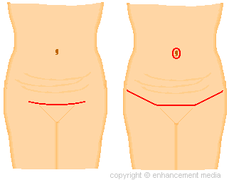 tummy tuck incisions